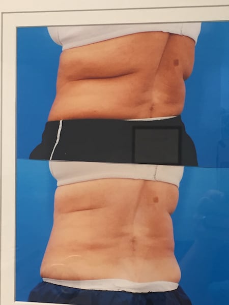 before and after cool sculpting