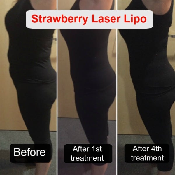 Before and after strawberry laser liposuction